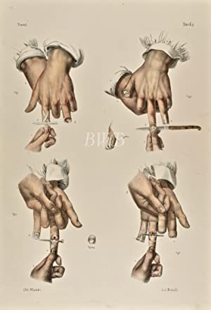 Amputazioni sopra la mano [Amputations of the hand]