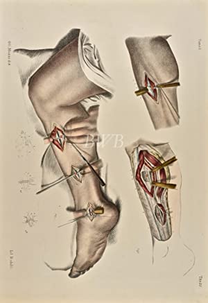 Allacciatura delle arterie tibiale posteriore, e peronea [Lacing of the posterior tibial artery and peroneal artery]