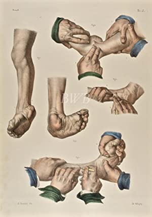 Operazioni sul piè tondo [Operations for round foot or clubfoot, 1]